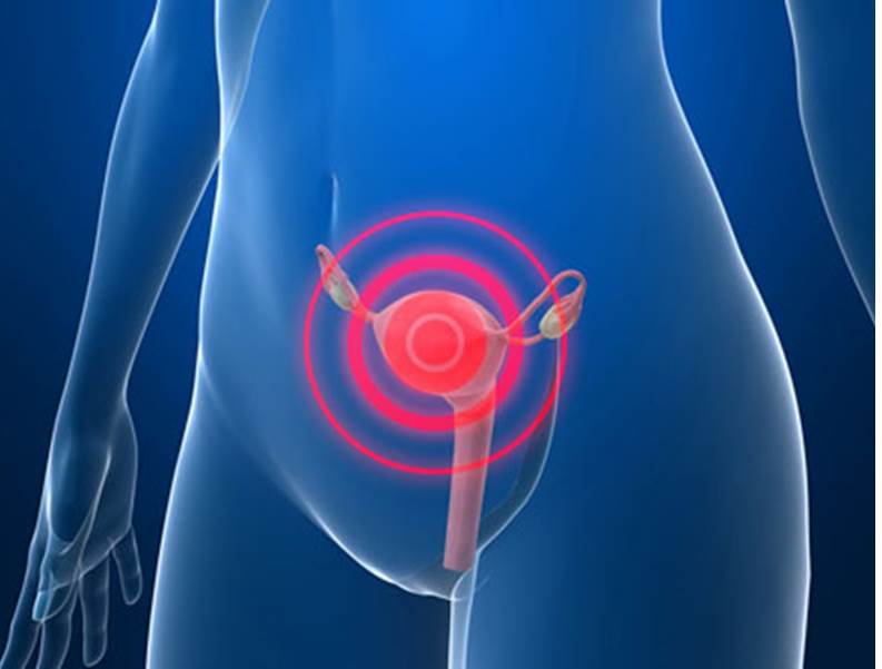 Cali sigue trabajando para disminuir la morbimortalidad por c�ncer de cuello uterino